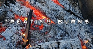 treating burns