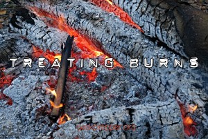 treating burns